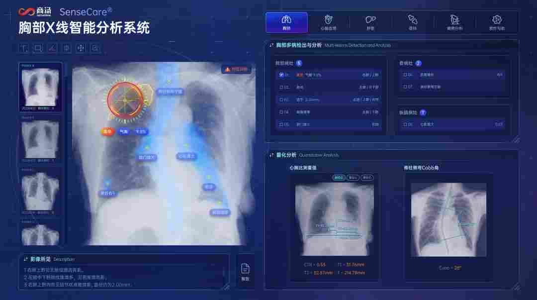 商汤医疗携手印尼Siloam落地SenseCare胸部X光智能分析解决方案